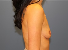 Breast Augmentation Before Photo by Derek Cody, MD, FACS; Akron, OH - Case 46951