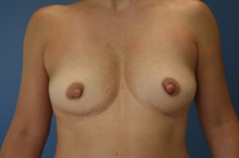 Breast Implant Removal After Photo by Derek Cody, MD, FACS; Akron, OH - Case 47180