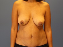 DIEP Flap Breast Reconstruction Before Photo by Derek Cody, MD, FACS; Akron, OH - Case 47183