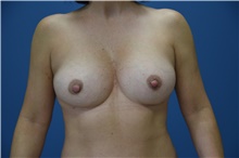 Breast Augmentation After Photo by Derek Cody, MD, FACS; Akron, OH - Case 47237