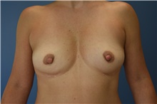 Breast Augmentation Before Photo by Derek Cody, MD, FACS; Akron, OH - Case 47237