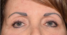 Eyelid Surgery After Photo by Derek Cody, MD, FACS; Akron, OH - Case 47811