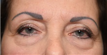 Eyelid Surgery Before Photo by Derek Cody, MD, FACS; Akron, OH - Case 47811
