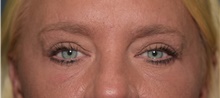 Eyelid Surgery After Photo by Derek Cody, MD, FACS; Akron, OH - Case 47813