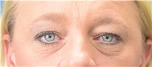 Eyelid Surgery Before Photo by Derek Cody, MD, FACS; Akron, OH - Case 47813