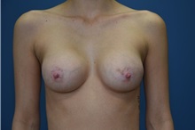 Breast Augmentation After Photo by Derek Cody, MD, FACS; ,  - Case 50633