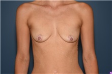 Breast Augmentation Before Photo by Derek Cody, MD, FACS; ,  - Case 50633