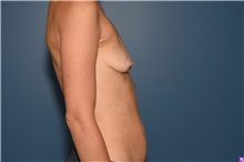 Breast Augmentation Before Photo by Derek Cody, MD, FACS; ,  - Case 50633
