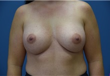 Breast Augmentation After Photo by Derek Cody, MD, FACS; ,  - Case 50634