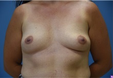 Breast Augmentation Before Photo by Derek Cody, MD, FACS; ,  - Case 50634