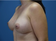 Breast Augmentation After Photo by Derek Cody, MD, FACS; ,  - Case 50634
