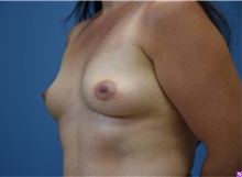 Breast Augmentation Before Photo by Derek Cody, MD, FACS; ,  - Case 50634