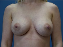Breast Augmentation After Photo by Derek Cody, MD, FACS; ,  - Case 50635