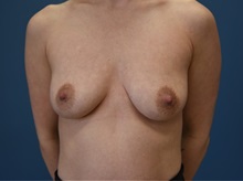 Breast Augmentation Before Photo by Derek Cody, MD, FACS; ,  - Case 50635
