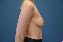 Breast Augmentation Before Photo by Derek Cody, MD, FACS; ,  - Case 50635