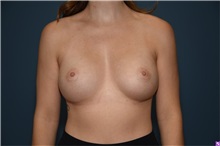Breast Augmentation After Photo by Derek Cody, MD, FACS; ,  - Case 50636