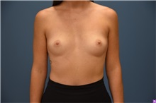 Breast Augmentation Before Photo by Derek Cody, MD, FACS; ,  - Case 50636