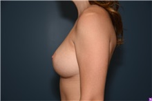 Breast Augmentation After Photo by Derek Cody, MD, FACS; ,  - Case 50636