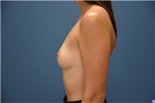 Breast Augmentation Before Photo by Derek Cody, MD, FACS; ,  - Case 50636