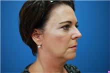 Facelift Before Photo by Derek Cody, MD, FACS; ,  - Case 50718