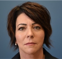 Facelift After Photo by Derek Cody, MD, FACS; ,  - Case 50718