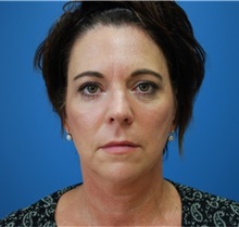 Facelift Before Photo by Derek Cody, MD, FACS; ,  - Case 50718