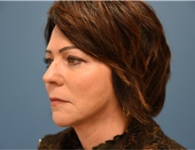 Facelift After Photo by Derek Cody, MD, FACS; ,  - Case 50718