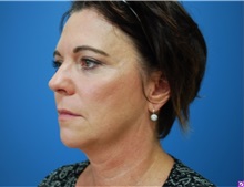 Facelift Before Photo by Derek Cody, MD, FACS; ,  - Case 50718