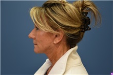 Facelift After Photo by Derek Cody, MD, FACS; ,  - Case 50782