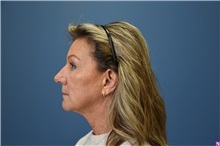 Facelift Before Photo by Derek Cody, MD, FACS; ,  - Case 50782