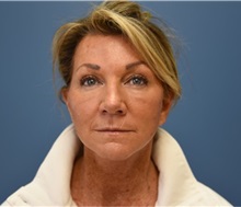 Facelift After Photo by Derek Cody, MD, FACS; ,  - Case 50782