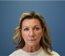 Facelift Before Photo by Derek Cody, MD, FACS; ,  - Case 50782