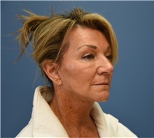 Facelift After Photo by Derek Cody, MD, FACS; ,  - Case 50782