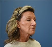 Facelift Before Photo by Derek Cody, MD, FACS; ,  - Case 50782