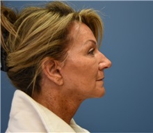 Facelift After Photo by Derek Cody, MD, FACS; ,  - Case 50782