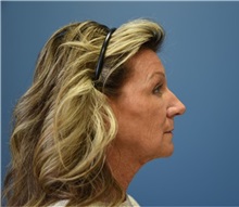 Facelift Before Photo by Derek Cody, MD, FACS; ,  - Case 50782