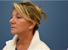 Facelift After Photo by Derek Cody, MD, FACS; ,  - Case 50782