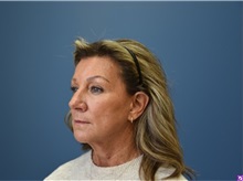Facelift Before Photo by Derek Cody, MD, FACS; ,  - Case 50782
