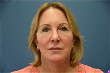 Facelift After Photo by Derek Cody, MD, FACS; ,  - Case 50791