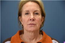 Facelift Before Photo by Derek Cody, MD, FACS; ,  - Case 50791