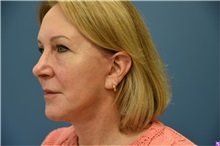 Facelift After Photo by Derek Cody, MD, FACS; ,  - Case 50791