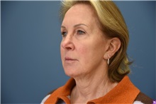 Facelift Before Photo by Derek Cody, MD, FACS; ,  - Case 50791