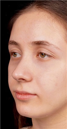 Rhinoplasty After Photo by Guncel Ozturk, Assoc. Prof. Dr, FEBOPRAS; Istanbul, M - Case 50980