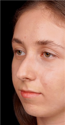 Rhinoplasty Before Photo by Guncel Ozturk, Assoc. Prof. Dr, FEBOPRAS; Istanbul, M - Case 50980