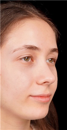 Rhinoplasty After Photo by Guncel Ozturk, Assoc. Prof. Dr, FEBOPRAS; Istanbul, M - Case 50980
