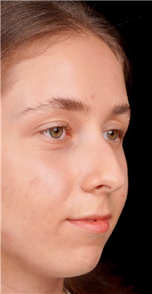 Rhinoplasty Before Photo by Guncel Ozturk, Assoc. Prof. Dr, FEBOPRAS; Istanbul, M - Case 50980