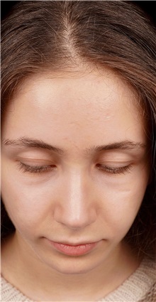 Rhinoplasty After Photo by Guncel Ozturk, Assoc. Prof. Dr, FEBOPRAS; Istanbul, M - Case 50980