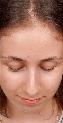 Rhinoplasty Before Photo by Guncel Ozturk, Assoc. Prof. Dr, FEBOPRAS; Istanbul, M - Case 50980