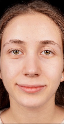 Rhinoplasty After Photo by Guncel Ozturk, Assoc. Prof. Dr, FEBOPRAS; Istanbul, M - Case 50980