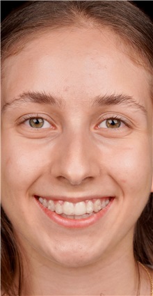 Rhinoplasty Before Photo by Guncel Ozturk, Assoc. Prof. Dr, FEBOPRAS; Istanbul, M - Case 50980